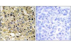 Immunohistochemistry analysis of paraffin-embedded human breast carcinoma tissue, using ENTK Antibody. (TMPRSS15 anticorps  (AA 81-130))