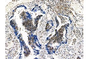Phospho-n-Myc (Ser261/Ser263) Antibody at 1/100 staining Human colorectal cancer by IHC-P. (MYCN anticorps  (pSer261, pSer263))