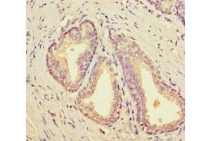 Immunohistochemistry of paraffin-embedded human prostate cancer using ABIN7161699 at dilution of 1:100 (SCP2 anticorps  (AA 1-143))