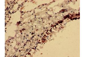 Immunohistochemistry analysis of human lung cancer using ABIN7153105 at dilution of 1:100 (FOXR2 anticorps  (AA 1-300))