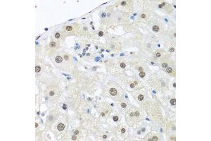 Immunohistochemistry of paraffin-embedded human breast carcinoma using UBC antibody.