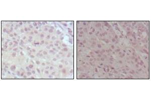 Immunohistochemical analysis of paraffin-embedded human lung cancer (left) and esophagus cancer (right), showing nuclear weak staining with DAB staining using MLL mouse mAb. (MLL/KMT2A anticorps  (AA 3751-3968))
