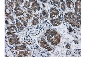 Immunohistochemical staining of paraffin-embedded Carcinoma of liver tissue using anti-ATP5B mouse monoclonal antibody. (ATP5B anticorps)