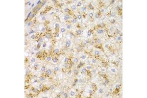 Immunohistochemistry of paraffin-embedded human liver cancer using ACTN1 antibody.