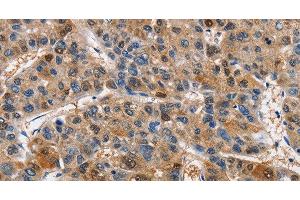 Immunohistochemistry of paraffin-embedded Human liver cancer tissue using PIM1 Polyclonal Antibody at dilution 1:40 (PIM1 anticorps)