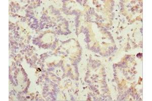 Immunohistochemistry of paraffin-embedded human lung cancer using ABIN7169185 at dilution of 1:100 (SIK3 anticorps  (AA 60-310))
