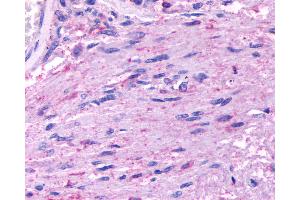 Anti-HTR5A / 5-HT5A Receptor antibody IHC of human Brain, Glioblastoma.