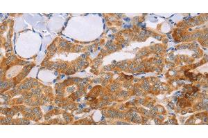 Immunohistochemistry of paraffin-embedded Human thyroid cancer tissue using CARD6 Polyclonal Antibody at dilution 1:60 (CARD6 anticorps)