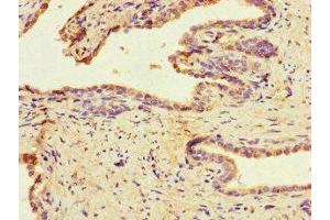 Immunohistochemistry of paraffin-embedded human prostate cancer using ABIN7159790 at dilution of 1:100 (MAST1 anticorps  (AA 687-879))