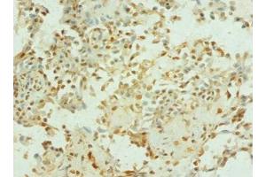 Immunohistochemistry of paraffin-embedded human breast cancer using  at dilution of 1: 100 (TEP1 anticorps  (AA 2-226))