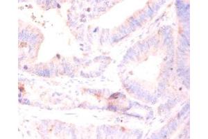 Immunohistochemistry of paraffin-embedded human colon cancer using ABIN7142829 at diluton of 1:50 (RPL5 anticorps  (AA 2-297))