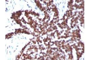 Formalin-fixed, paraffin-embedded human ovarian carcinoma stained with Cyclin B1 antibody.