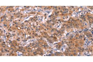 Immunohistochemistry of paraffin-embedded Human gastic cancer using HMGCS1 Polyclonal Antibody at dilution of 1:40 (HMGCS1 anticorps)