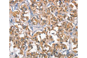 Immunohistochemistry of Human gastric cancer using HGF Polyclonal Antibody at dilution of 1:65 (HGF anticorps)
