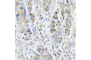 Immunohistochemistry of paraffin-embedded human liver cancer using VAPB Antibody (ABIN1876551) at dilution of 1:200 (40x lens). (VAPB anticorps)