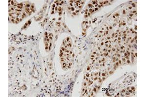 Immunoperoxidase of monoclonal antibody to PBK on formalin-fixed paraffin-embedded human cholangiocarcinoma. (PBK anticorps  (AA 1-30))
