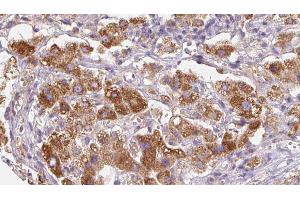 ABIN6279753 at 1/100 staining Human liver cancer tissue by IHC-P. (PTPRK anticorps  (Internal Region))