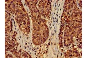 Immunohistochemistry of paraffin-embedded human ovarian cancer using ABIN7151428 at dilution of 1:100