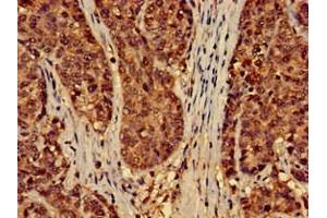 Immunohistochemistry of paraffin-embedded human ovarian cancer using ABIN7151428 at dilution of 1:100 (EFHD2 anticorps  (AA 2-240))