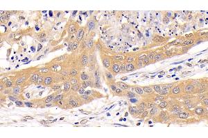 Detection of AMPK Alpha 1 in Human Lung cancer Tissue using Polyclonal Antibody to Protein Kinase, AMP Activated Alpha 1 (AMPK Alpha 1)