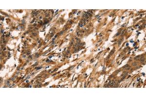 Immunohistochemistry of paraffin-embedded Human gastric cancer tissue using CD159a/c Polyclonal Antibody at dilution 1:30 (CD159a/c anticorps)