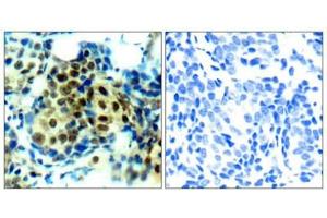 Immunohistochemical analysis of paraffin-embedded human breast carcinoma tissue using p44/42 MAP Kinase (Phospho-Thr202) Antibody (left) or the same antibody preincubated with blocking peptide (right). (ERK1 anticorps  (pThr202))