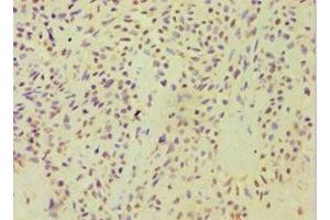 Immunohistochemistry of paraffin-embedded human breast cancer using ABIN7143446 at dilution of 1:100