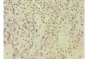 Immunohistochemistry of paraffin-embedded human breast cancer using ABIN7143446 at dilution of 1:100 (ARF3 anticorps  (AA 1-181))