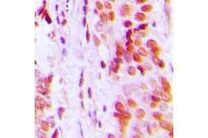 Immunohistochemical analysis of p57 Kip2 staining in human breast cancer formalin fixed paraffin embedded tissue section.