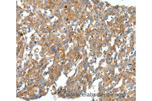 Immunohistochemistry of Human cervical cancer using CXCL12 Polyclonal Antibody at dilution of 1:40 (CXCL12 anticorps)