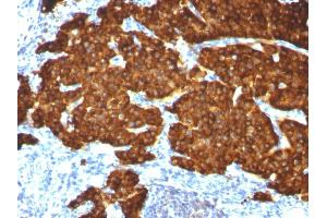 Formalin-fixed, paraffin-embedded Pheochromocytoma stained with Chromogranin A Monoclonal Antibody (CGA/413+ CHGA/777+ CHGA/798)
