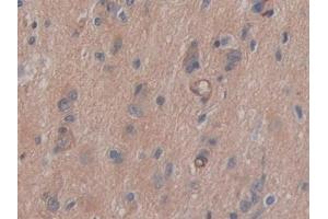 Detection of CD147 in Human Glioma Tissue using Polyclonal Antibody to Cluster Of Differentiation 147 (CD147)