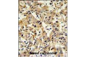 CA6 Antibody (C-term) (ABIN653737 and ABIN2843041) IHC analysis in formalin fixed and paraffin embedded breast carcinoma followed by peroxidase conjugation of the secondary antibody and DAB staining.