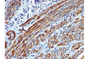 Formalin-fixed, paraffin-embedded human Leiomyosarcoma stained with SM-MHC Mouse Monoclonal Antibody (MYH11/923). (MYH11 anticorps)