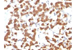 Formalin-fixed, paraffin-embedded human Thyroid Carcinoma stained with Cytokeratin 18 Mouse Monoclonal Antibody (C-04). (Cytokeratin 18 anticorps)