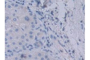 Detection of YARS in Human Liver cancer Tissue using Polyclonal Antibody to Tyrosyl tRNA Synthetase (YARS)