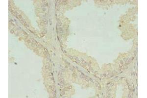Immunohistochemistry of paraffin-embedded human prostate cancer using ABIN7147106 at dilution of 1:100