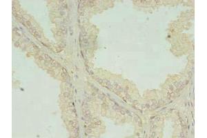 Immunohistochemistry of paraffin-embedded human prostate cancer using ABIN7147106 at dilution of 1:100 (RQCD1 anticorps  (AA 1-258))
