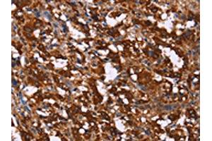 The image on the left is immunohistochemistry of paraffin-embedded Human thyroid cancer tissue using ABIN7190739(GAGE12I Antibody) at dilution 1/20, on the right is treated with synthetic peptide. (G Antigen 12I anticorps)