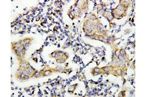 Anti-Caspase-8(P10) antibody, IHC(P) IHC(P): Human Mammary Cancer Tissue