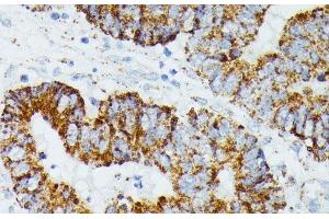 Immunohistochemistry of paraffin-embedded Human colon carcinoma using ETHE1 Polyclonal Antibody at dilution of 1:100 (40x lens). (ETHE1 anticorps)