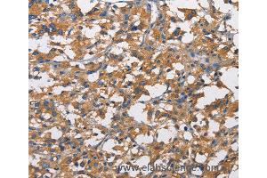 Immunohistochemistry of Human liver cancer using NT5E Polyclonal Antibody at dilution of 1:50 (CD73 anticorps)
