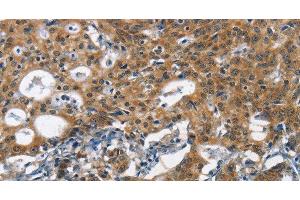 Immunohistochemistry of paraffin-embedded Human gasrtic cancer tissue using DCC Polyclonal Antibody at dilution 1:70 (DCC anticorps)