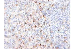 Formalin-fixed, paraffin-embedded Melanoma stained with Tyrosinase Rabbit Recombinant Monoclonal Antibody (TYR/2024R). (Recombinant TYR anticorps)
