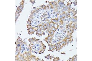Immunohistochemistry of paraffin-embedded human lung cancer using HAL antibody (ABIN6130467, ABIN6141593, ABIN6141594 and ABIN6216851) at dilution of 1:100 (40x lens).