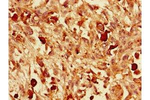 Immunohistochemistry of paraffin-embedded human melanoma using ABIN7161441 at dilution of 1:100 (VGF anticorps  (AA 23-206))