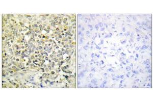 Immunohistochemistry analysis of paraffin-embedded human lung carcinoma tissue using CDKL4 antibody. (CDKL4 anticorps  (C-Term))