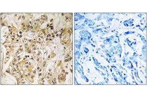 Immunohistochemistry analysis of paraffin-embedded human breast carcinoma tissue, using ZNF295 Antibody. (ZNF295 anticorps  (AA 731-780))