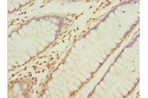 Immunohistochemistry of paraffin-embedded human colon cancer using ABIN7153563 at dilution of 1:100