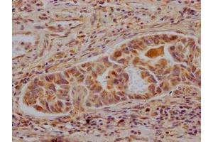 IHC image of ABIN7127333 diluted at 1:100 and staining in paraffin-embedded human liver cancer performed on a Leica BondTM system.